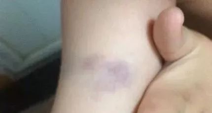 身体淤青自愈是什么病,最近身上出现淤青是怎么回事