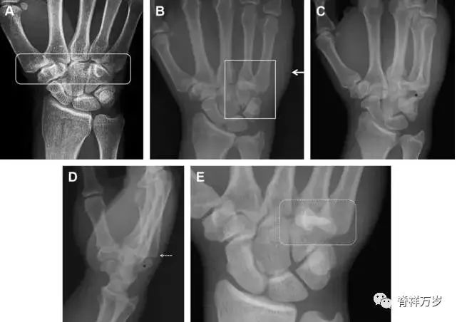 肩关节脱位易漏诊的骨折,放射科容易漏诊的骨折
