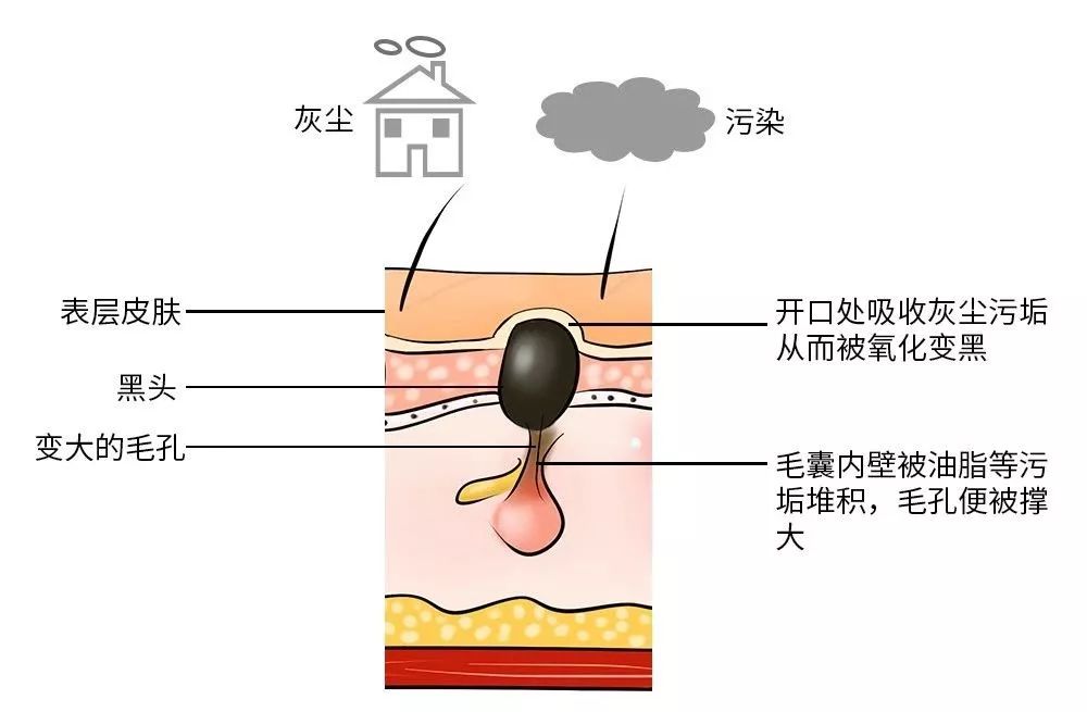 黑头太顽固教你去黑头的方法,去黑头小妙招你的黑头有救了