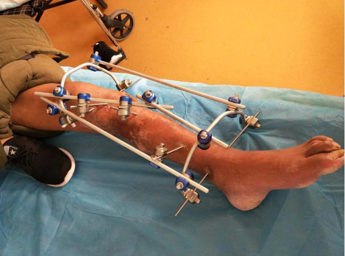 小腿部分断裂保守治疗,小腿离断再植康复训练