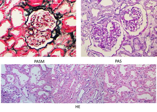 半夜突然血尿是什么原因引起的,感冒了肉眼看见血尿什么原因