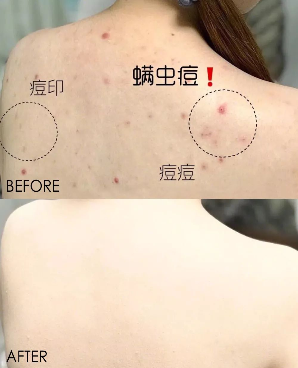 鼻尖挤出白色的是什么,鼻子上挤出的白丝怎么解决