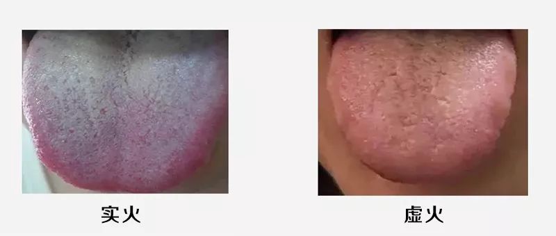祛火降火也要分“虚实”!别弄错了,反而会“雪上加霜”