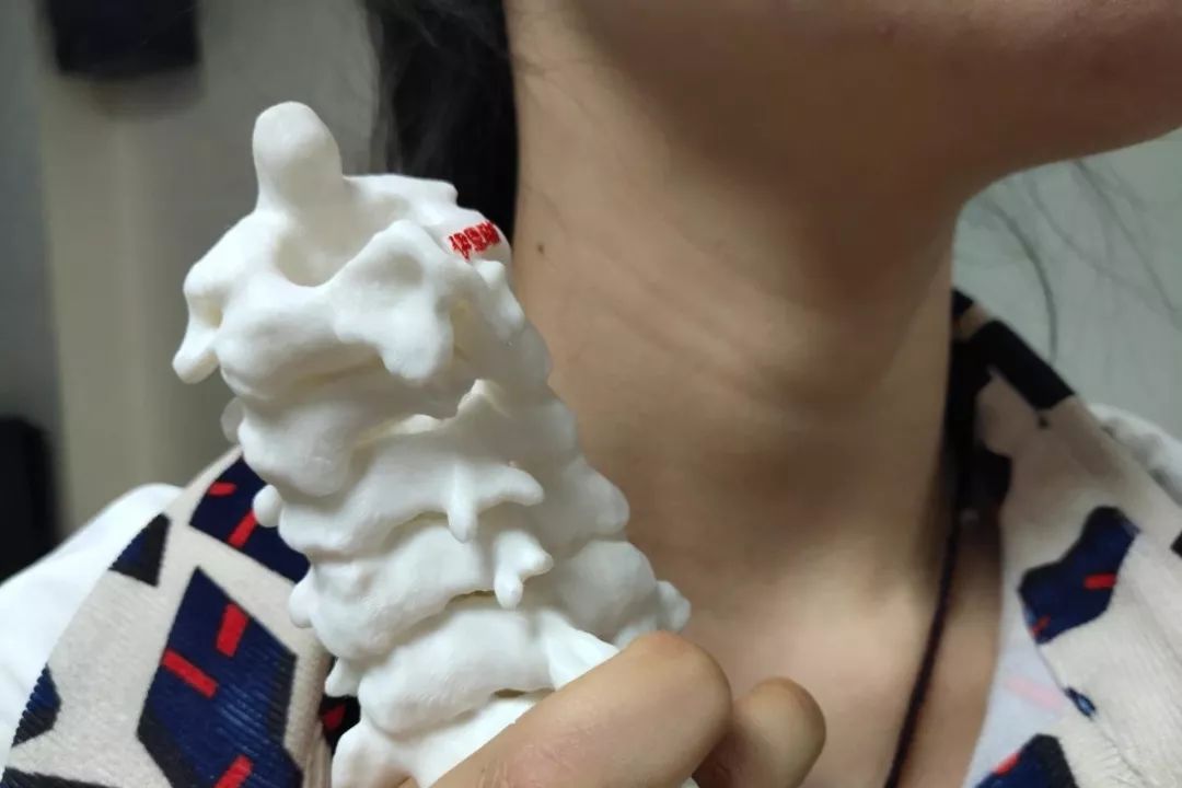 全球首例3D打印人体颈椎术，西安做到了！