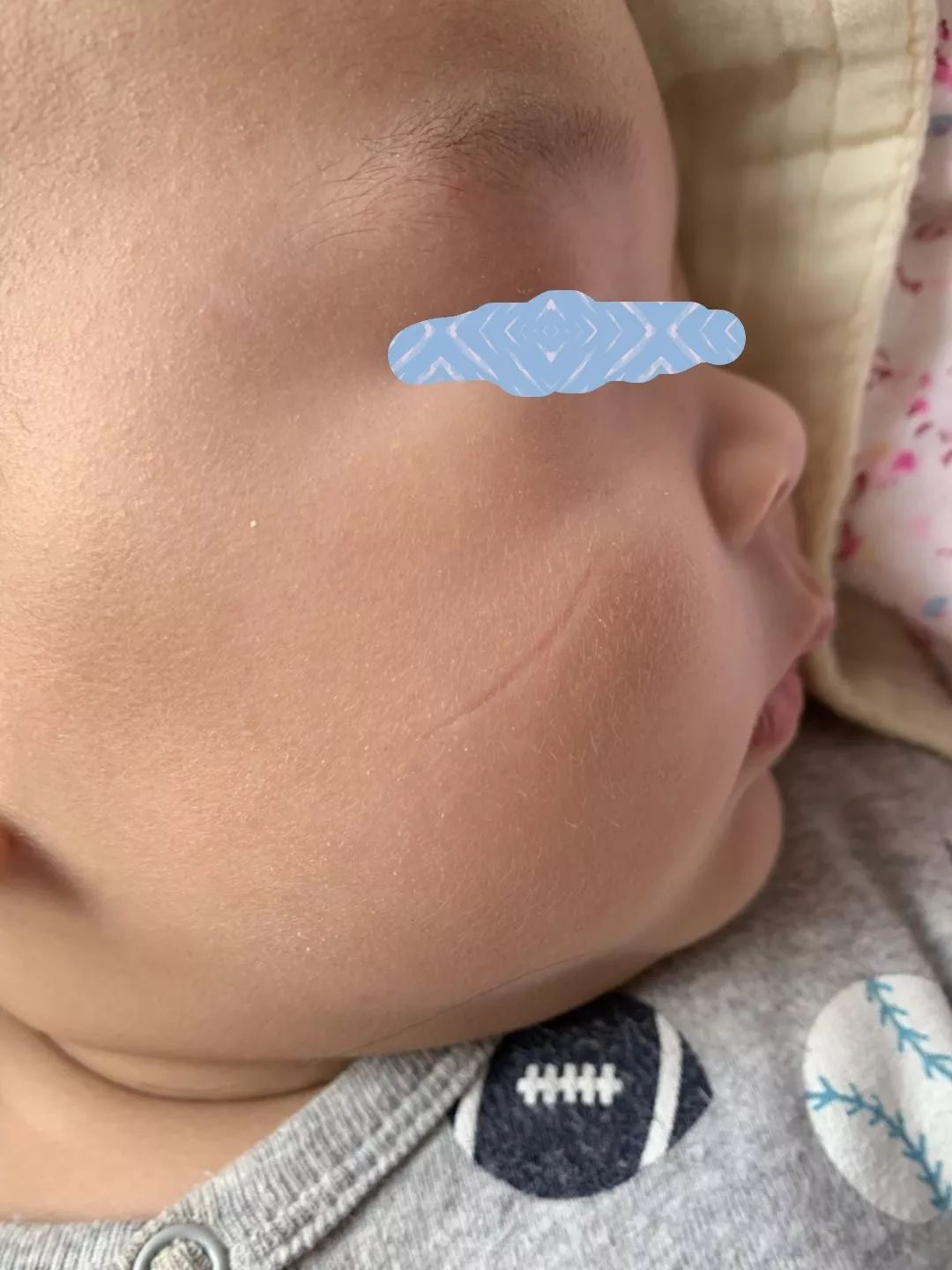 面部伤口美容缝合后注意事项,面部美容缝合视频