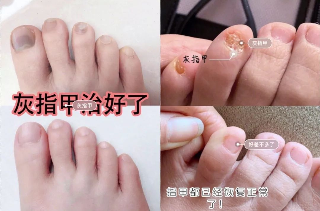 专治脚气的神奇药,十多年的脚气三味中药一招搞定