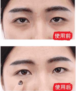 眼袋松弛下垂最快解决方法,严重眼袋下垂松弛怎么恢复