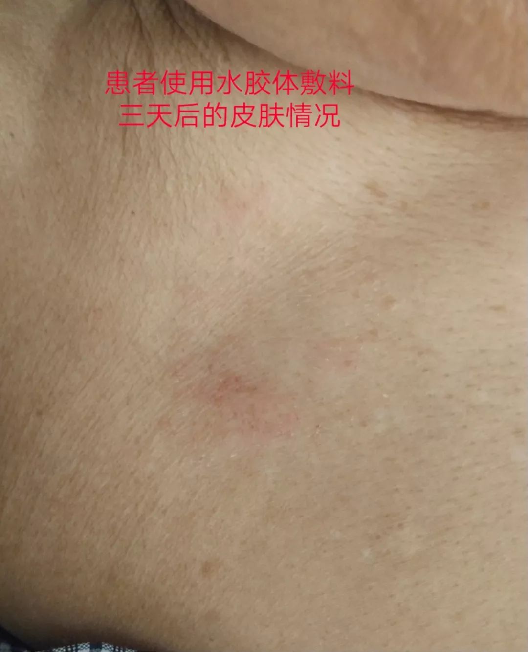 电极片皮试过敏,电极贴过敏的整改措施