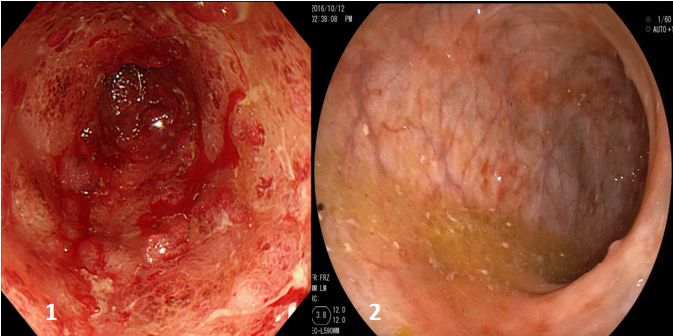 溃疡性结肠炎的诊疗过程医生笔记,溃疡性结肠炎协和