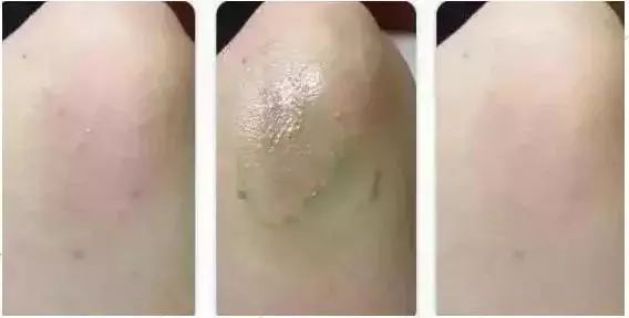 泰国蚊子咬止痒膏,防蚊虫叮咬药膏推荐泰国