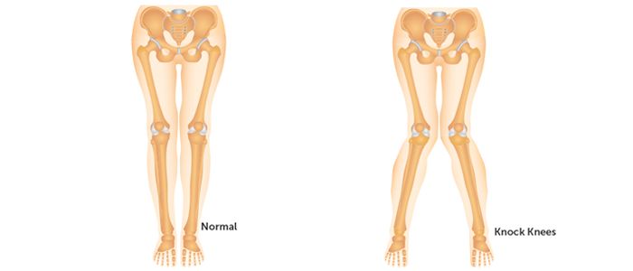 腿粗还不直小腿还外翻,怎么走路小腿才不会粗