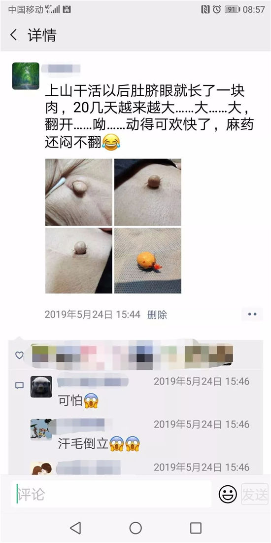 成人肚脐长小肉球,肚脐眼里面长了个肉球十几年