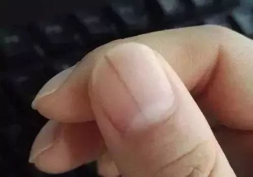 女子指甲上多出一条线没当回事，现在为保命竟要截掉
