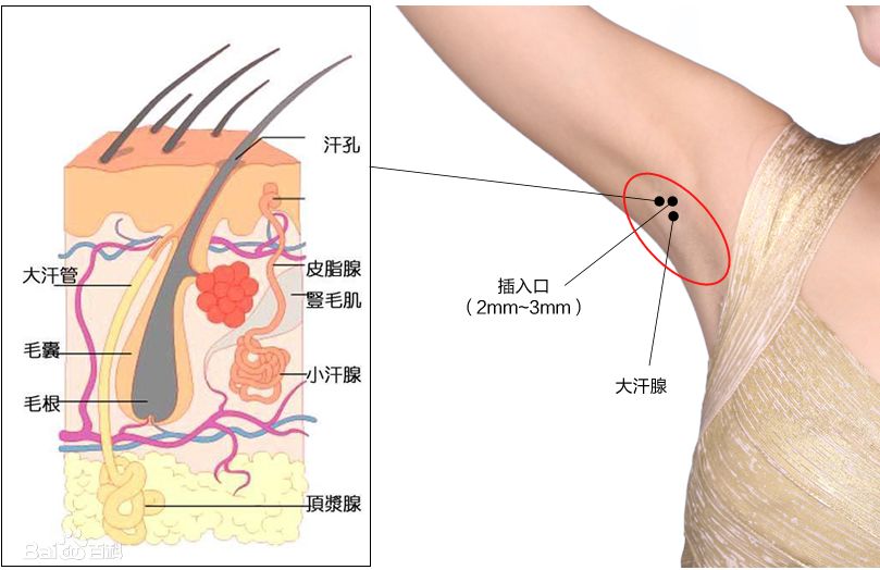 夏天腋窝出汗小神器,夏天腋窝出汗多用止汗露