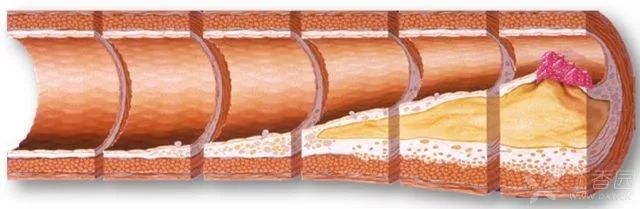 脑动脉硬化最佳运动,如何运动能治愈动脉斑块