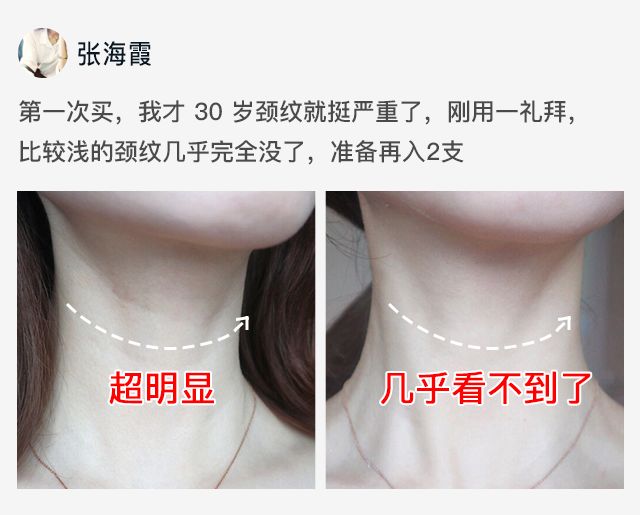 脖子长纹的女人,中年妇女脖子有几圈纹是怎么来的