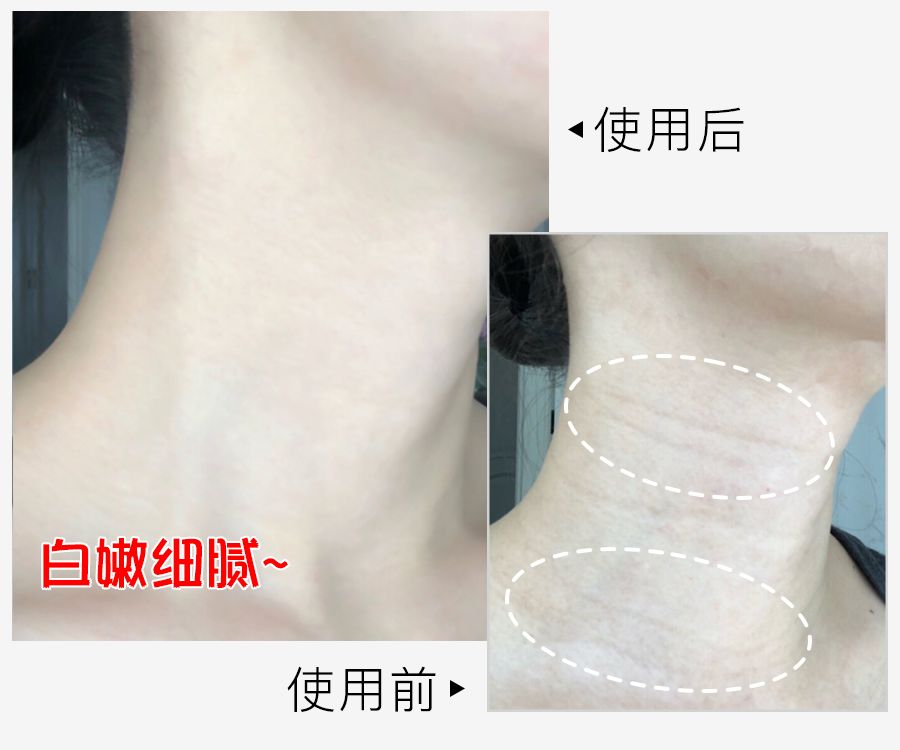 脖子长纹的女人,中年妇女脖子有几圈纹是怎么来的