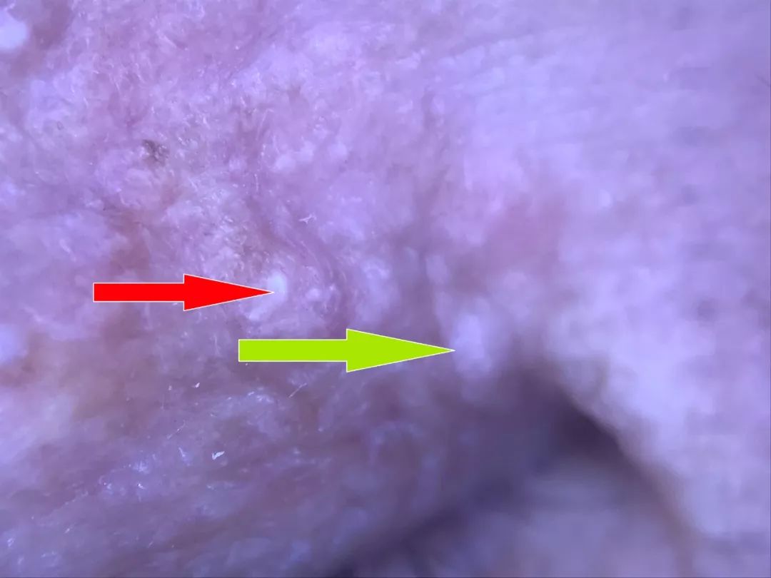 眼周细纹脂肪粒,动能素对眼周细纹有效果吗