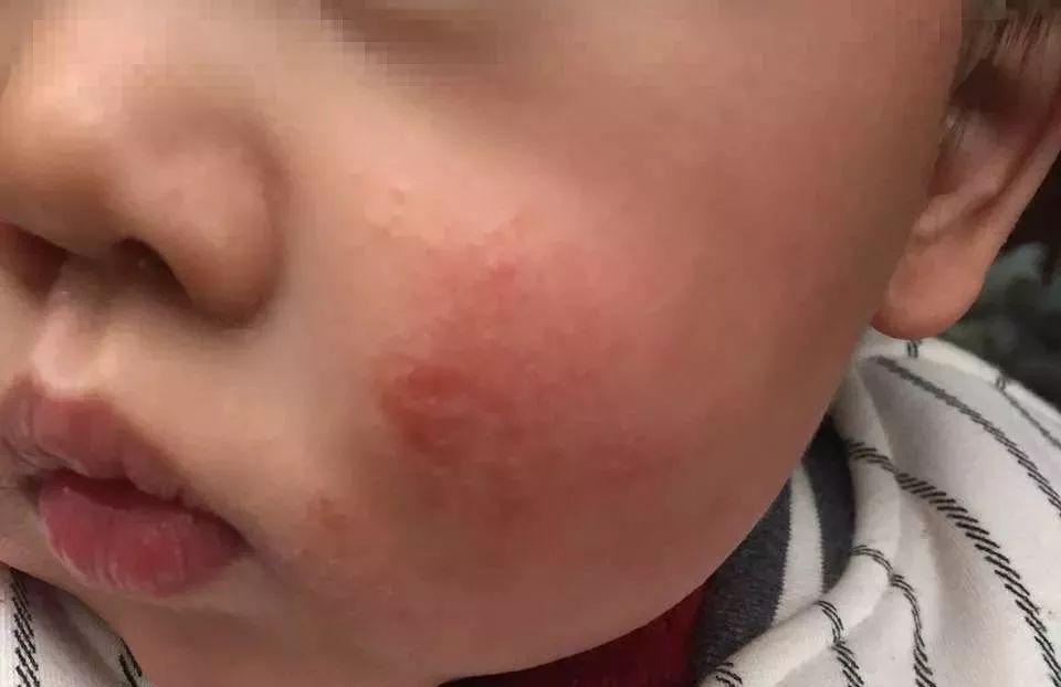 他克莫司软膏治疗脂溢性皮炎,面部皮肤脂溢性皮炎治疗方法