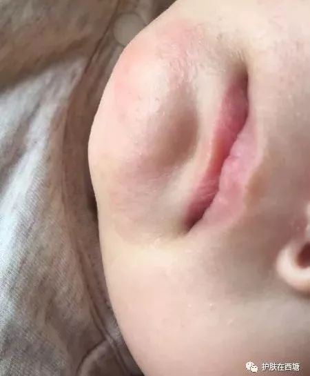 常见面部皮肤病,三脂溢性皮炎