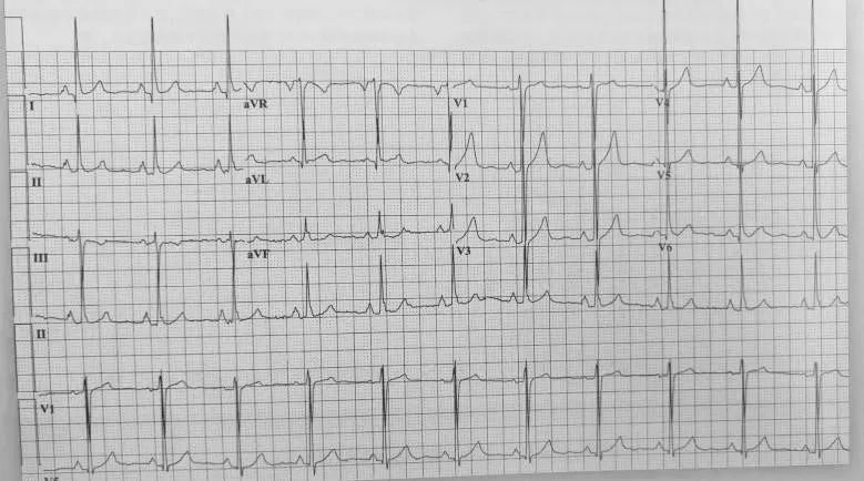 心电图上一个小格代表什么,心电图上有小波动你会怎么样