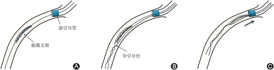 冠脉支架抗凝治疗专家共识,冠状动脉破裂的处理方法