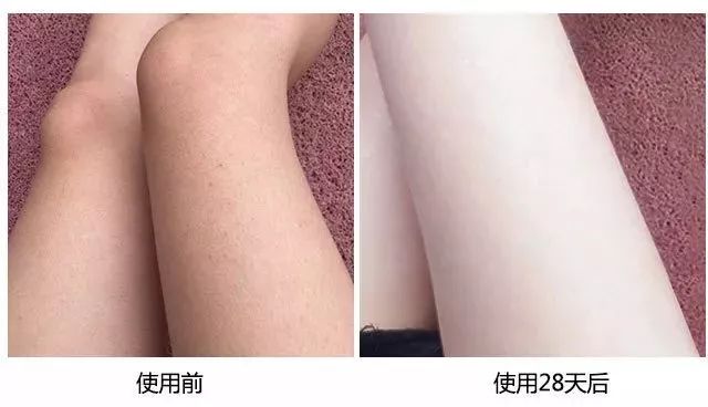 鸡皮肤永久消除,37天快速祛鸡皮肤