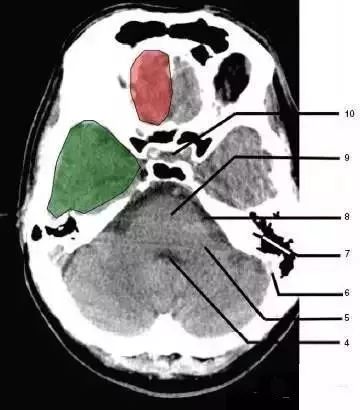 颅脑影像读片教程,颅脑影像读片怎么看
