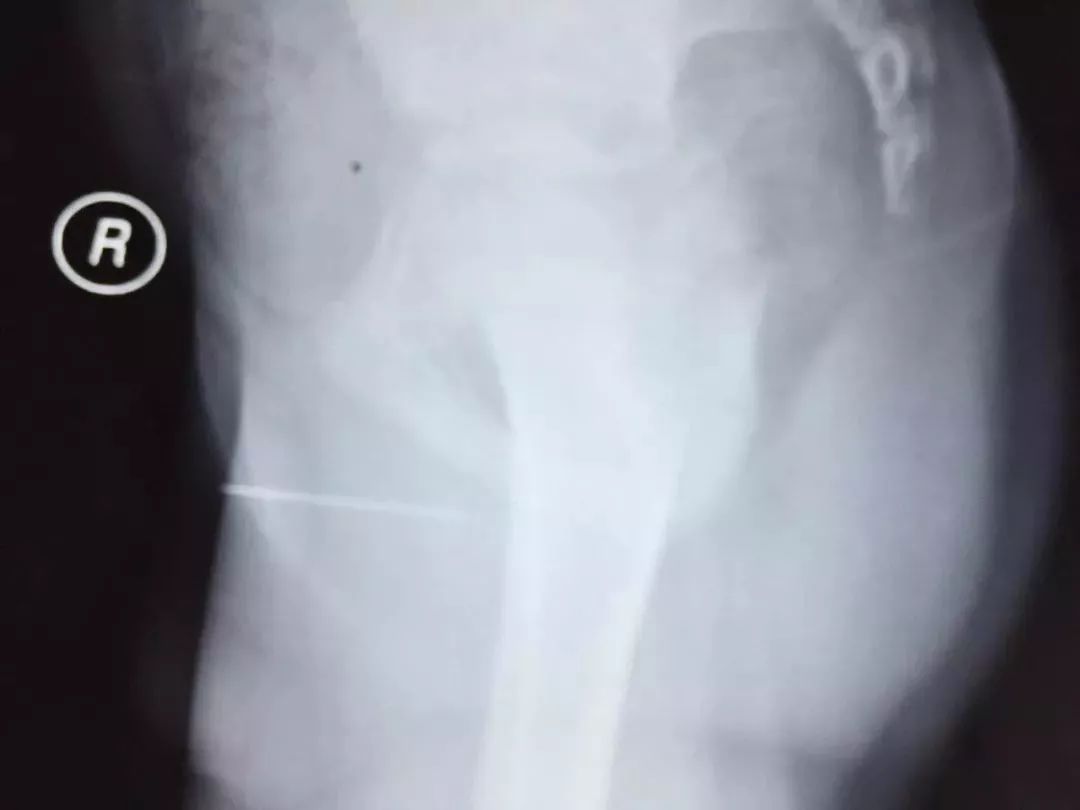 看着就很痛！广西一男孩竟将4.5厘米长缝衣针塞入*体下**…