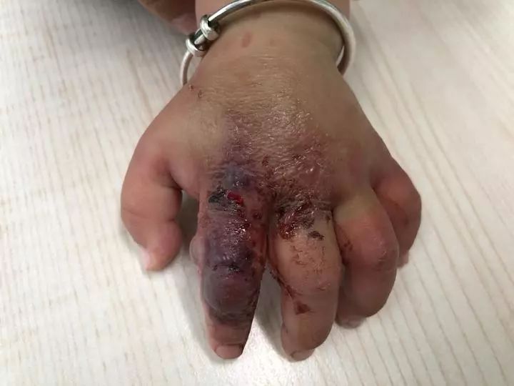 十个月宝宝手指肿有个泡,十个月婴儿手面肿