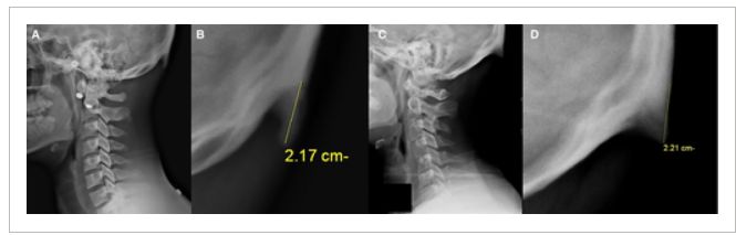 玩手机改变骨盆前倾,玩手机改变面貌有多大