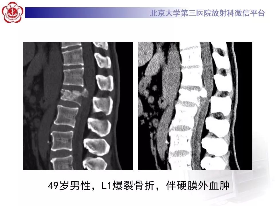 「每日一例｜893例」女，49岁，摔伤致腰部疼痛，活动受限1天