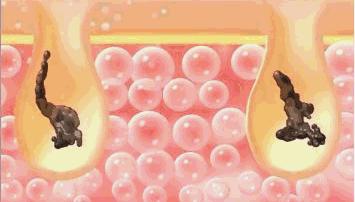 果酸适用何种痘,红痘印果酸