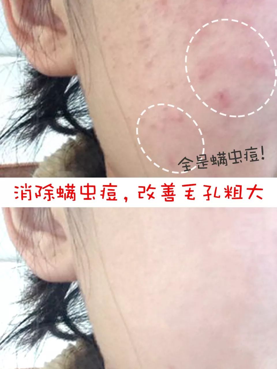 教你1分钟清除99%的脸上螨虫,10秒祛螨虫的药膏