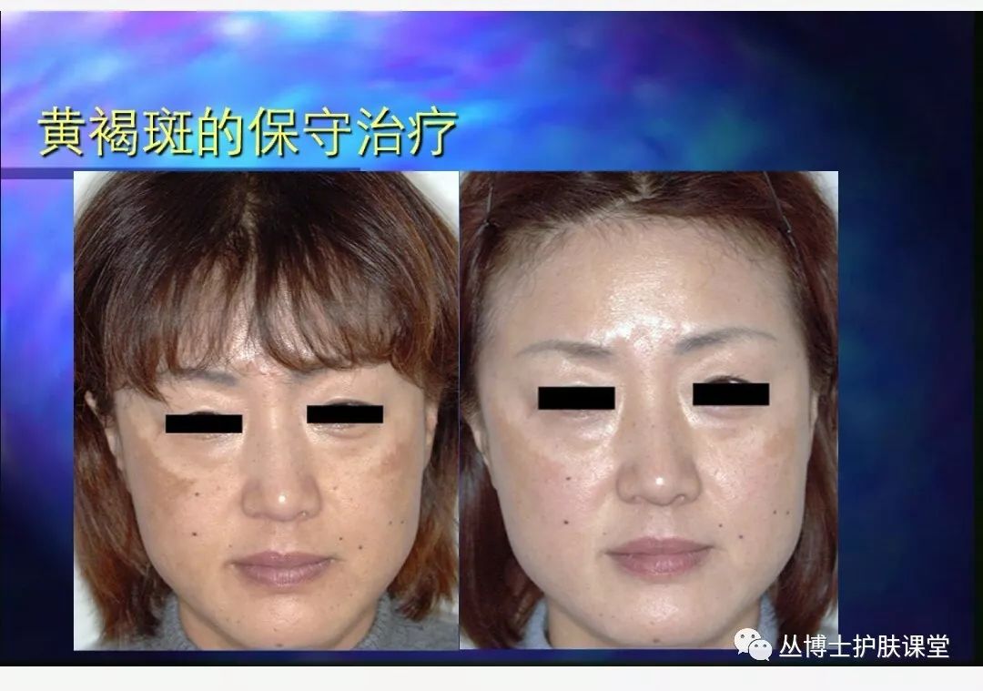 有什么好方法淡黄褐斑,褐斑怎么治疗最有效