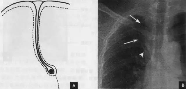 胸部ct解剖结构,胸部x线解读视频