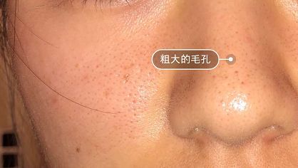 草莓鼻去黑头好物推荐使用,草莓鼻去黑头导出液