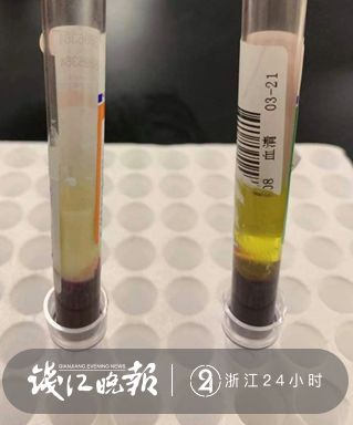 男子腹痛就医抽出牛奶血,男子腹痛住院抽出3000ml牛奶血