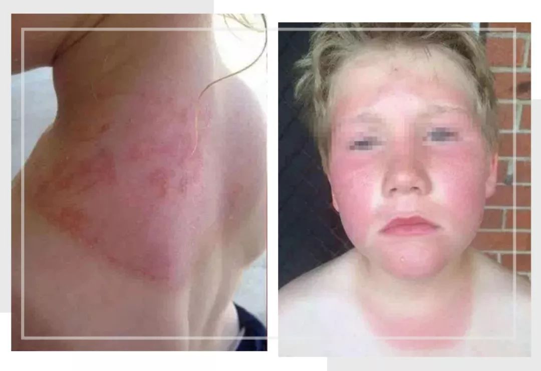 防晒=毁容？宝宝到底应该如何正确防晒？