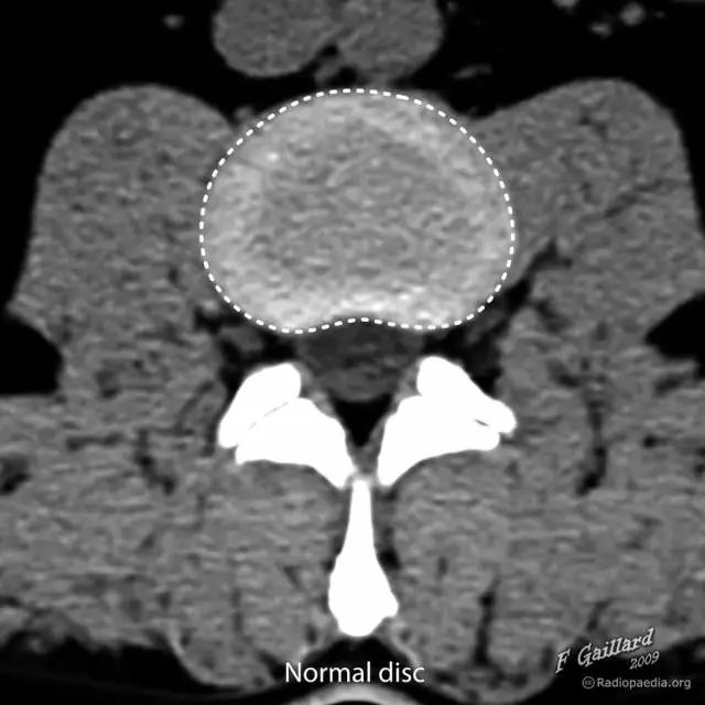 椎间盘膨出脱出图解,椎间盘膨出脱出和突出哪个更严重