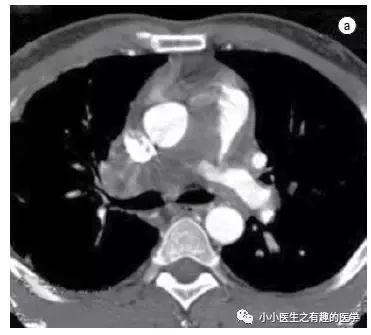 肺动脉分支充盈欠佳是肺栓塞吗,肺动脉缺损不可逆