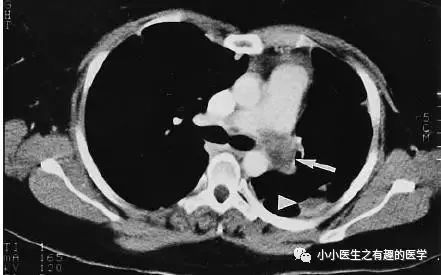 肺动脉分支充盈欠佳是肺栓塞吗,肺动脉缺损不可逆