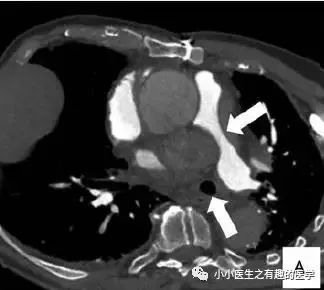 肺动脉分支充盈欠佳是肺栓塞吗,肺动脉缺损不可逆