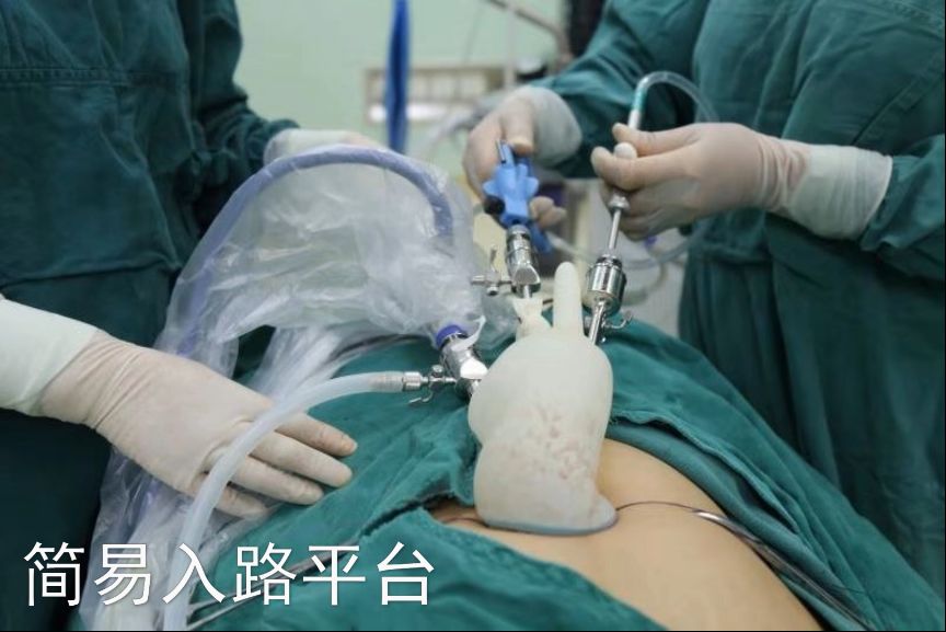 妇产科首例腹腔镜剔除子宫肌瘤,腹腔镜子宫肌瘤11厘米剔除术