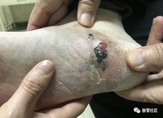 足部溃疡是什么症状,杏林微科普冬季手足皲裂怎么办