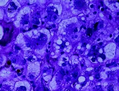 妊娠期急性脂肪肝的症状有哪些,妊娠期急性脂肪肝是什么引起的