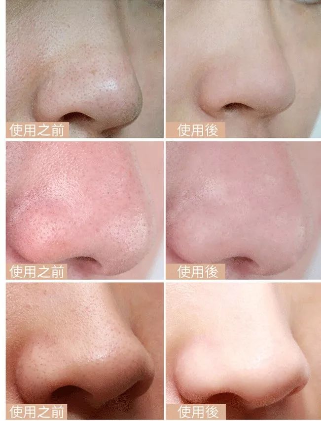 一抹吸出黑头,鸡蛋清除黑头