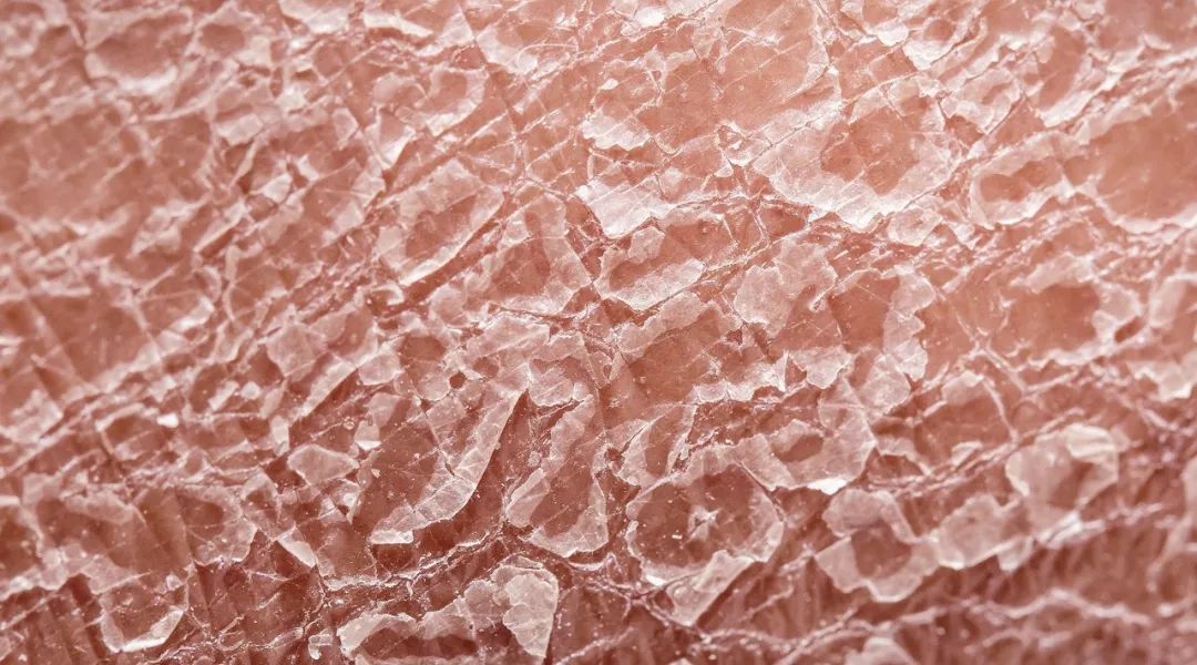 冬天皮肤起皮干燥有碎屑怎么保湿,下巴周围干燥起皮有小疙瘩