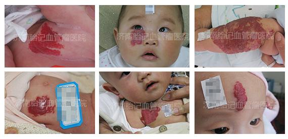 宝宝身上起红点当心这些皮肤病,嘴唇内壁长了个小红点是血管瘤吗