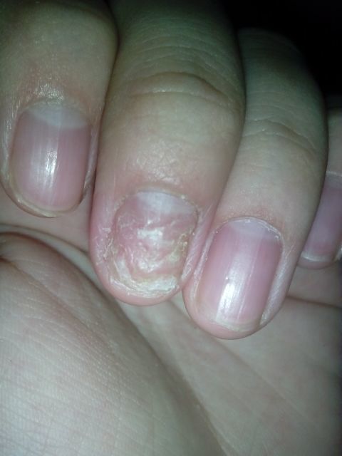 倪海厦讲灰指甲的治疗方法,大连灰指甲治疗最佳方法